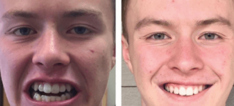 Invisalign - Clinique Dentaria Montreal Dentistes